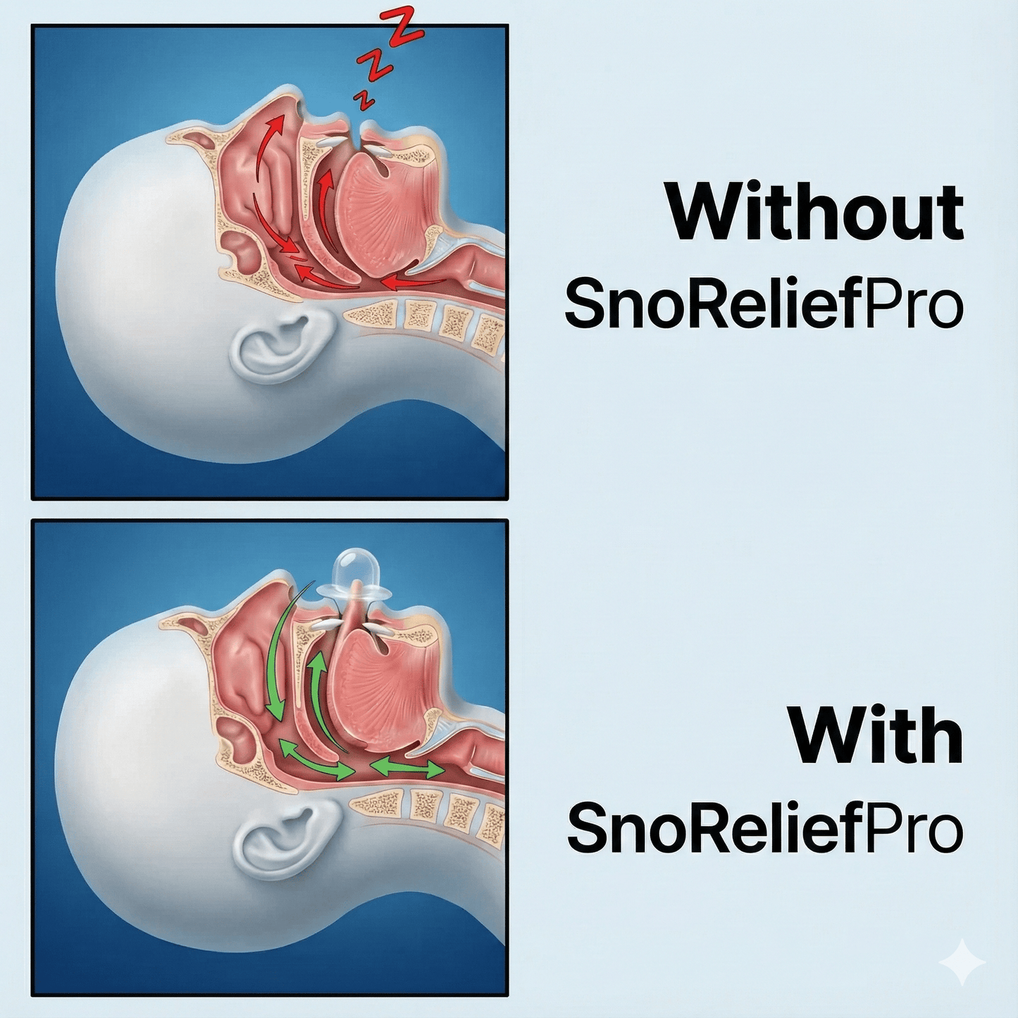 SnoReliefPro